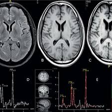 Final year project training on Fatal Brain anomaly detection Using Deep Learning in Pallikaranai, Chennai